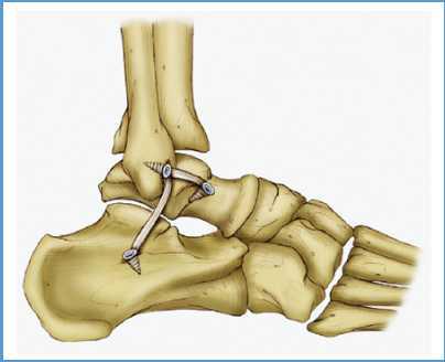 正 式踝关节外侧距腓前韧带和跟腓韧带断裂