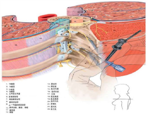 围术杂谈胸椎旁神经阻滞发生全脊麻怎么办