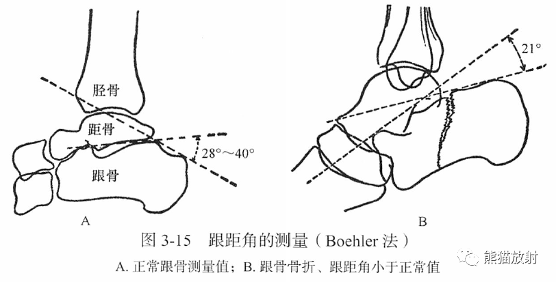 gissane角图片