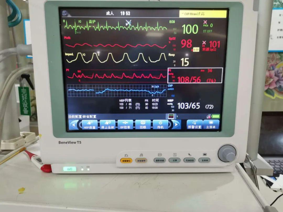 我院icu重症医学科成功开展有创动脉压监测