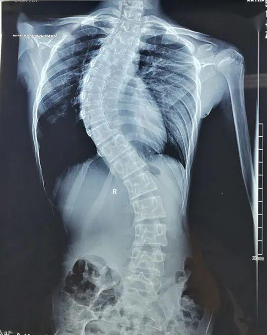 妙手仁心12岁女孩患极重度脊柱侧弯畸形专家手术矫正畸形让女孩长高4