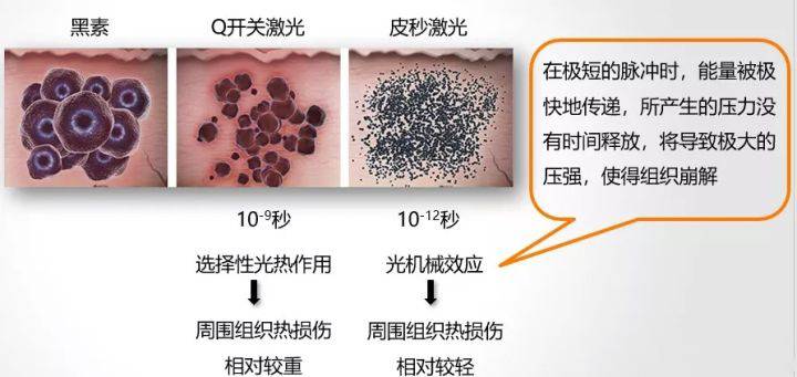 皮秒祛斑黑色系肌肤问题你是不是也遇到了