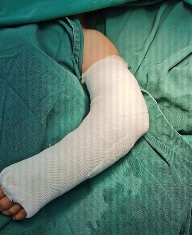 急诊来了个孩子,5岁,肱骨髁上骨折骨折,一来家长就要求手术