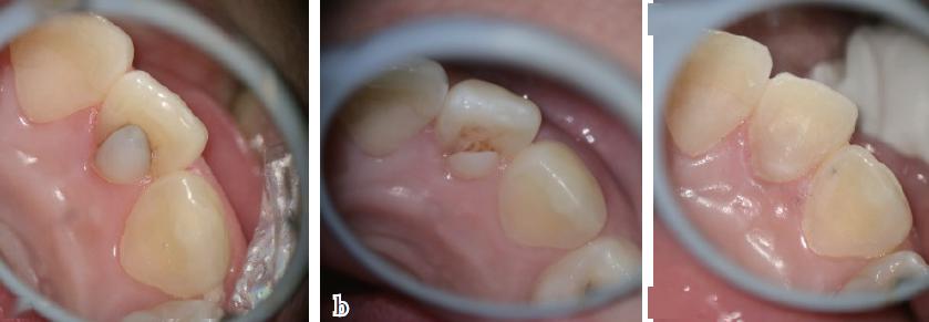 预防性原则牙内陷的凹陷较为狭窄,容易滞留细菌发生龋坏,且具有复杂的