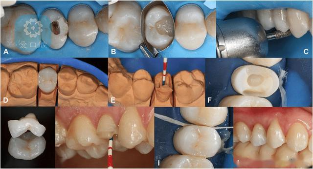 桩冠修复治疗过程图图片