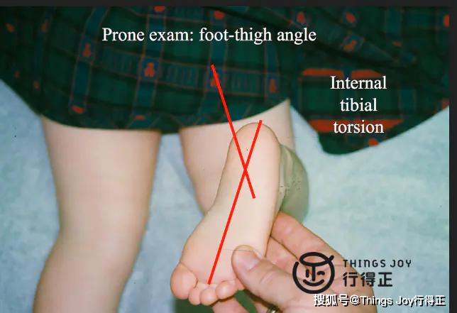 行得正儿童健康鞋告诉你如何判断孩子是否内八字脚