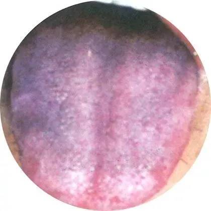 正常舌苔是淡红舌,薄白苔,舌苔淡白是寒气重的体现;有瘀斑的情况,就是