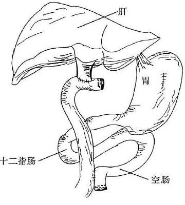 胃空肠rouxeny吻合图解图片