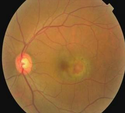 葡萄肿高度近视眼绝大多数为轴性近视,因眼轴的前后直径不断延长,眼底