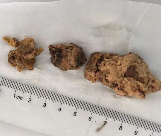 女患者胃里结石大如鹅蛋,钢丝都切不动, 医生:每天喝4升可乐,先喝十天