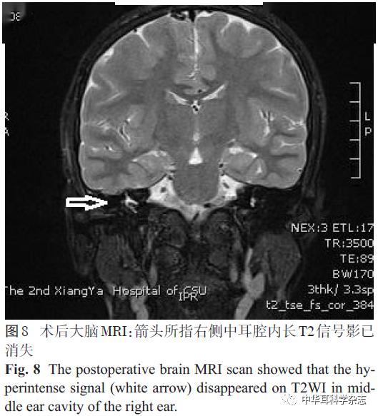 经外耳道水下耳内镜修复先天性内耳畸形伴脑脊液耳漏1例并文献复习