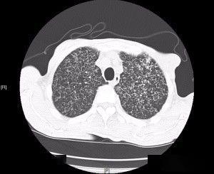急性粟粒性肺结核图片