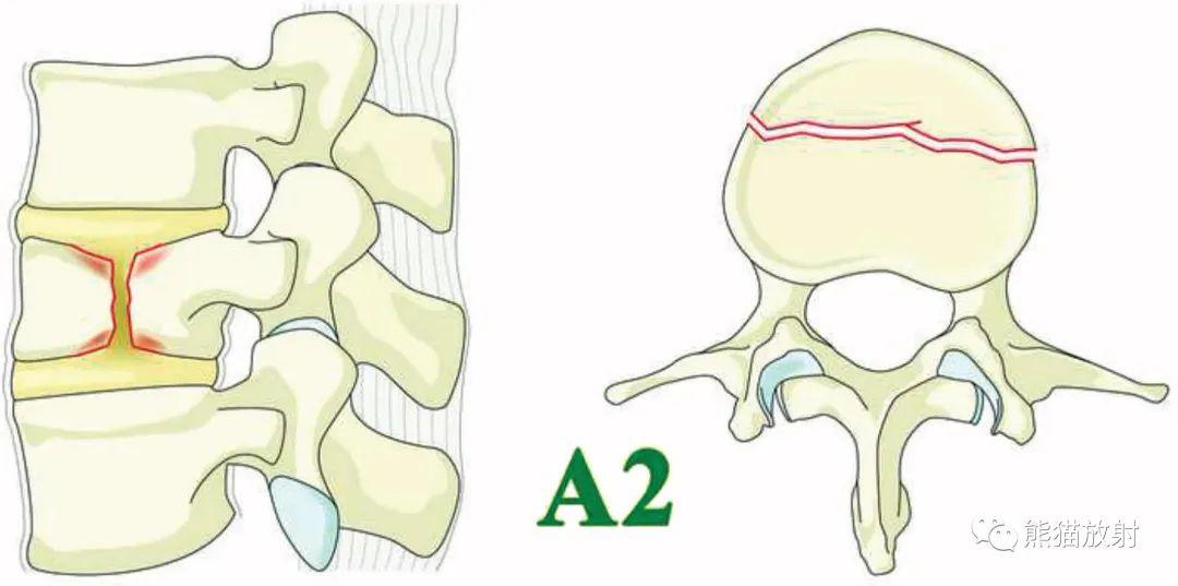 aospine胸腰椎損傷分類系統