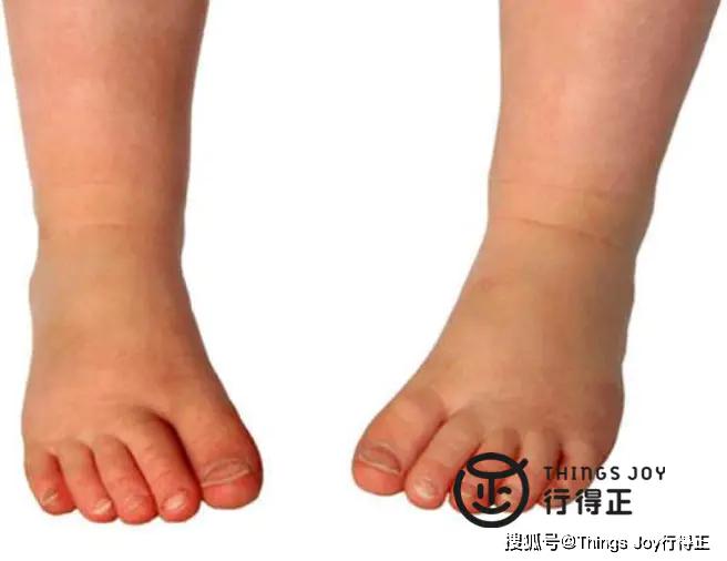 行得正儿童健康鞋告诉你如何判断孩子是否内八字脚