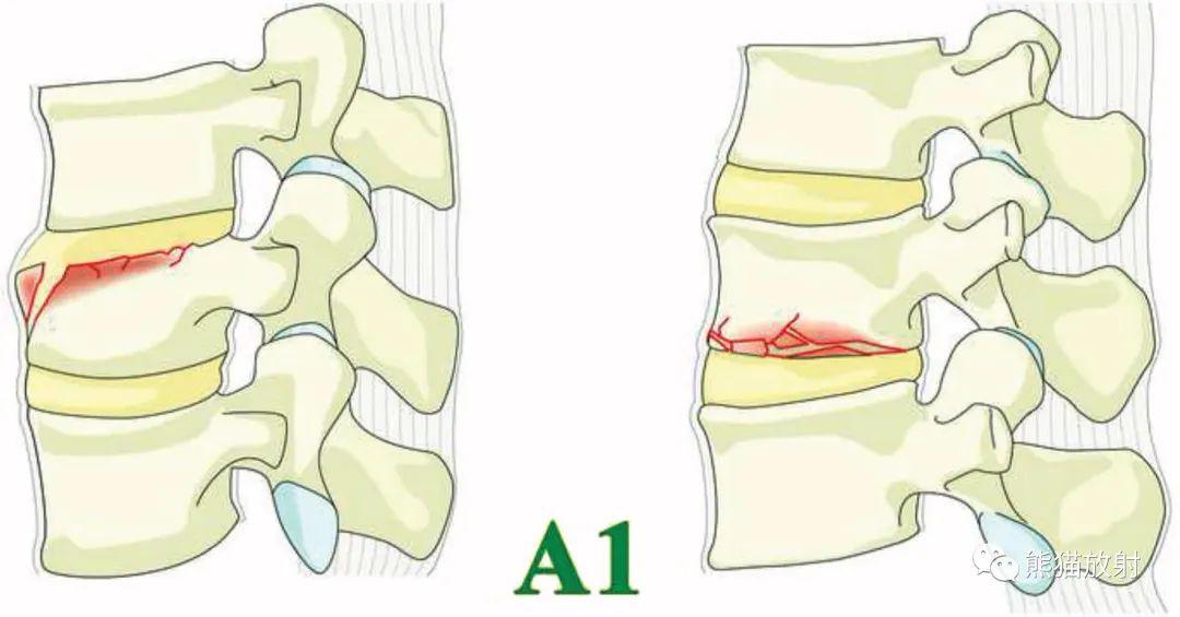 a1亚型-边缘压缩:单一终板骨折未累及椎体后壁.椎管完好无损.图-5.