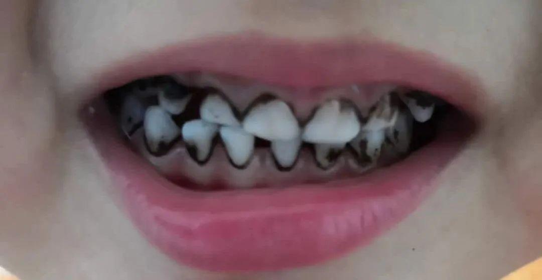 小朋友黑牙齿的照片图片