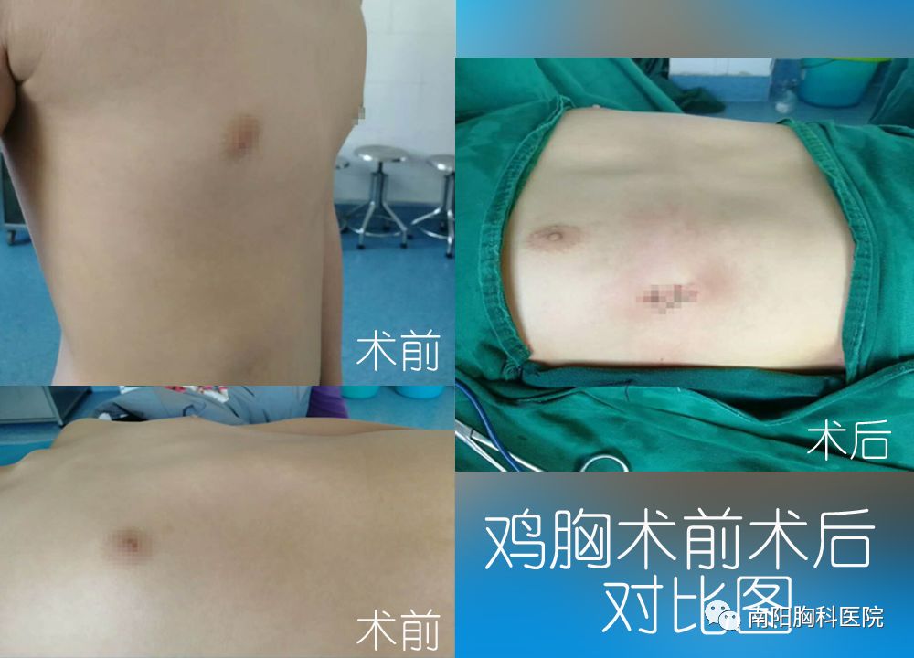 13岁鸡胸患者,采用微创鸡胸矫正手术(南阳胸科医院)