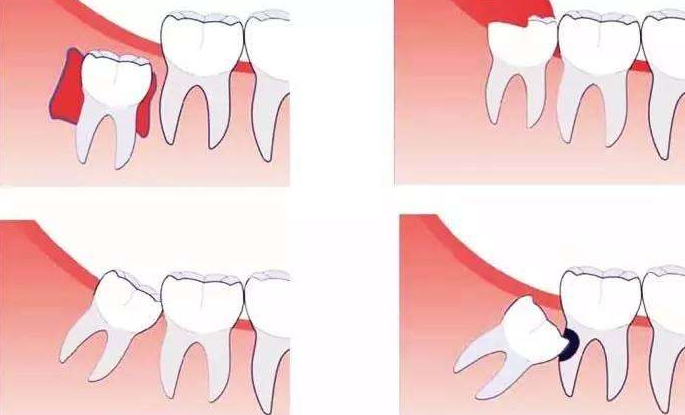 智齿冠周炎:一种难以言喻的疼痛
