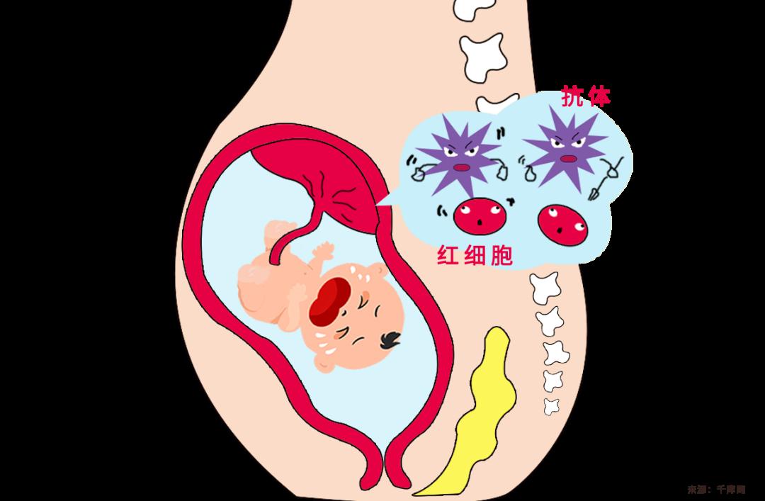 4,溶血严重的婴幼儿可能会出现一系列反应.