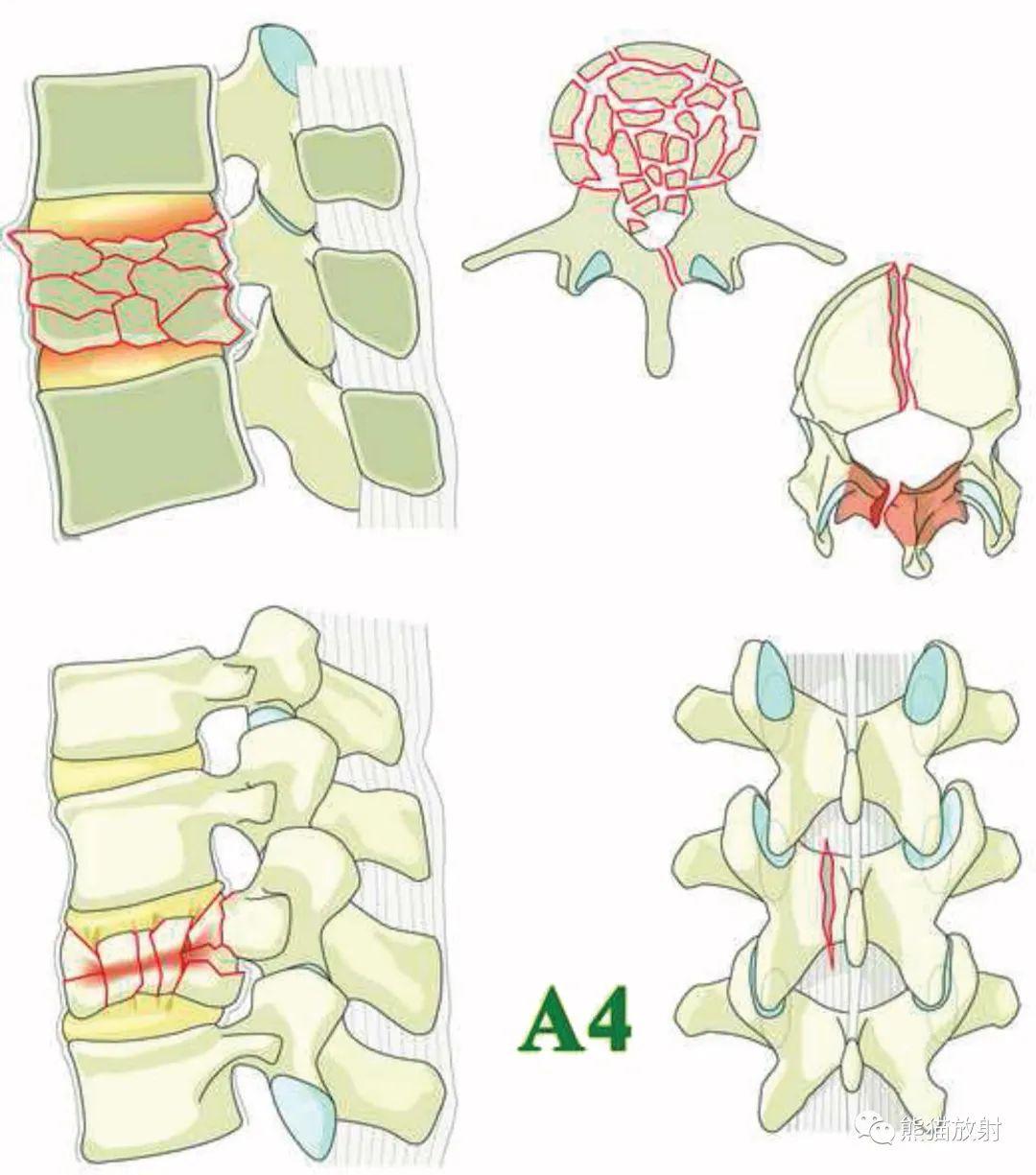 aospine胸腰椎损伤分类系统