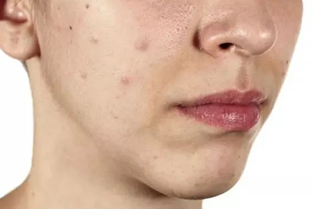 珂语护肤:祛除黑痘印,你怎能不知道这几样利器?_黑色素