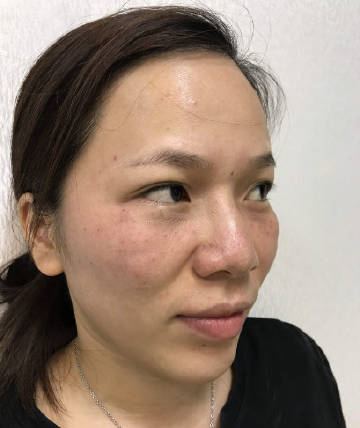 压力大等因素导致色斑由于皮脂腺分泌旺盛,容易形成"炎症后色素沉着"