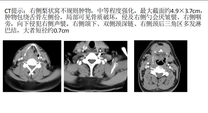 下咽癌解剖图片