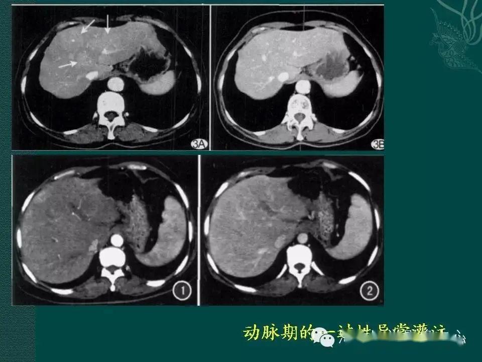 靜脈主幹狹窄閉塞伴側枝循環,脾腎靜脈交通膽囊靜脈增粗形成假腫瘤徵