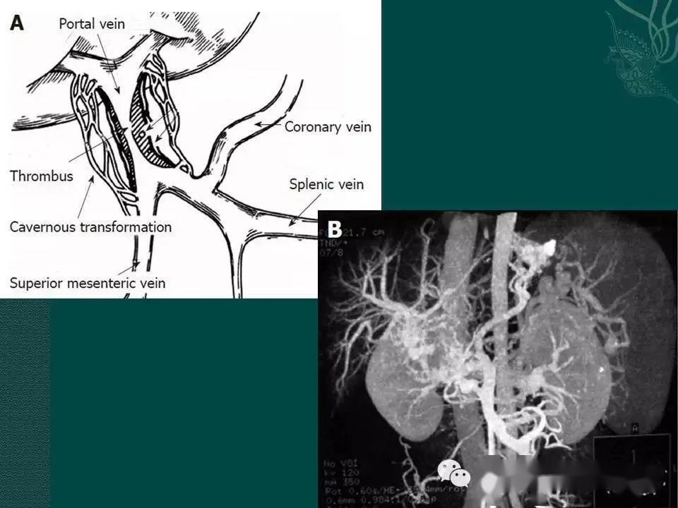 临床提示:消化道出血,你会想到ctpv吗?_门静脉