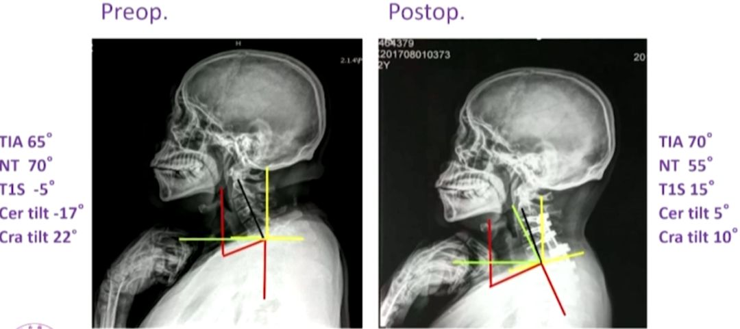 术前见患者颈椎胸椎后凸畸形97 诊断:帕金森病合并颈椎后凸畸形97