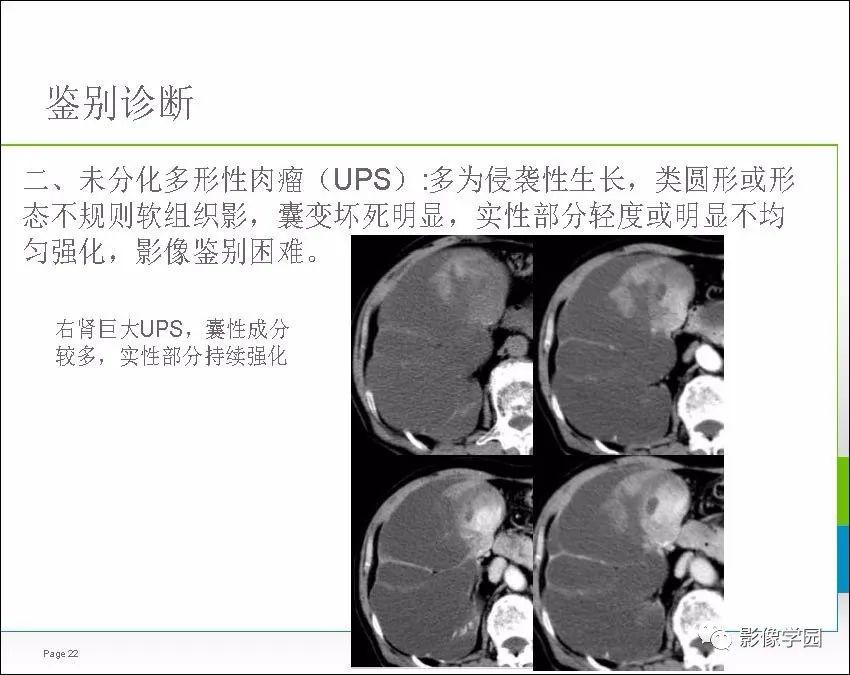 每日一例1050肾脏滑膜肉瘤