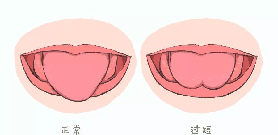 兒童舌頭短說話不清楚怎麼辦