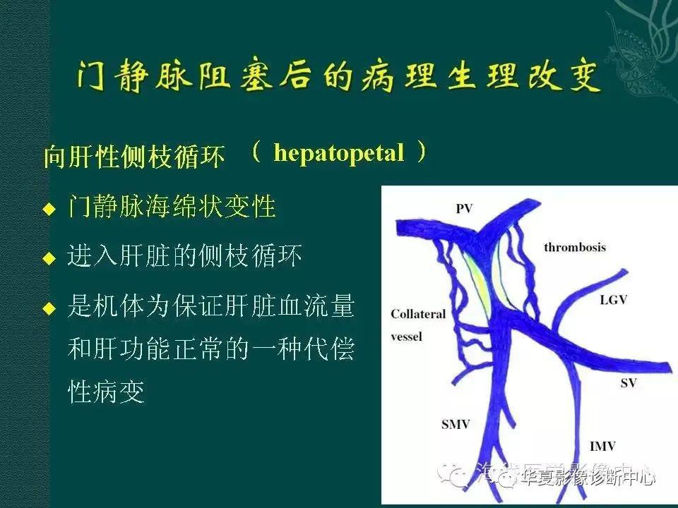 门静脉工字型图片