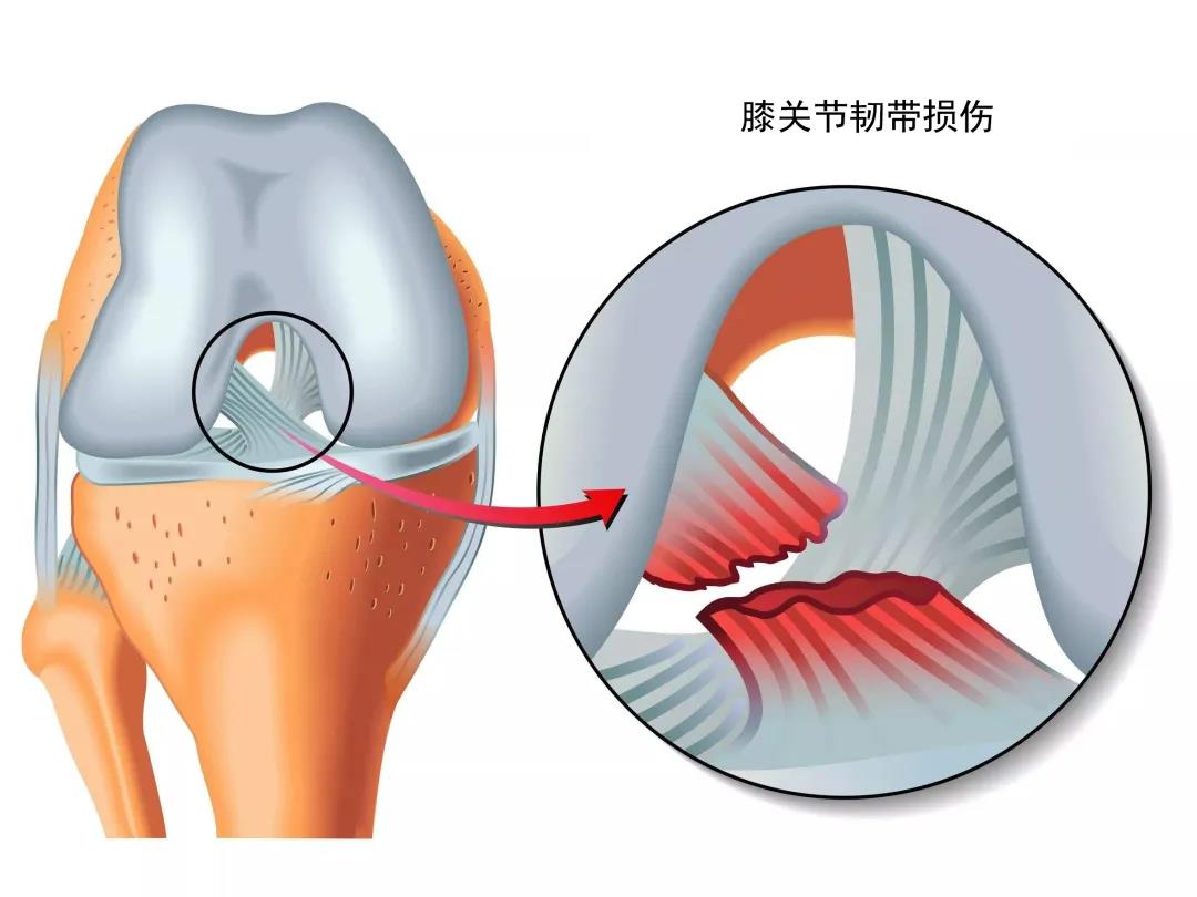 和派圓針11種膝關節疼痛的原因及護理治療完美乾貨