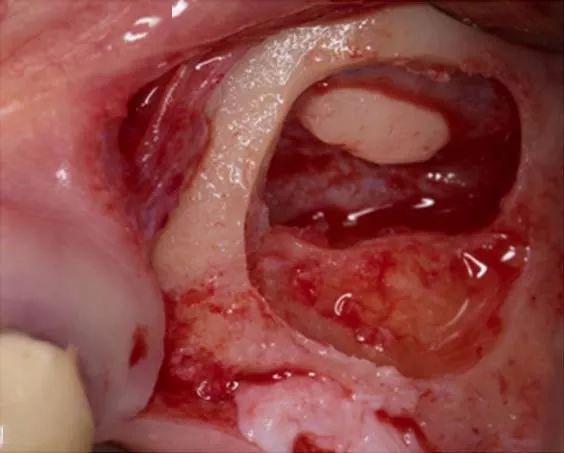 牙医学堂计算机引导的侧壁开窗的上颌窦底提升同期种植体植入