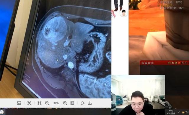 原创pdd临时停播肝肿瘤病情加重时隔2年下决心切除谈手术风险极大