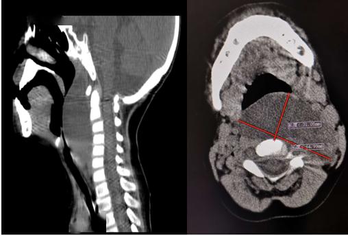 颈部巨大淋巴管瘤险窒息微创精准施治挽救患儿生命