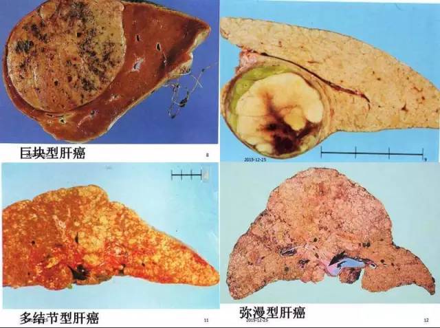 多结节型:常发生于肝硬变的肝内,散在的瘤结