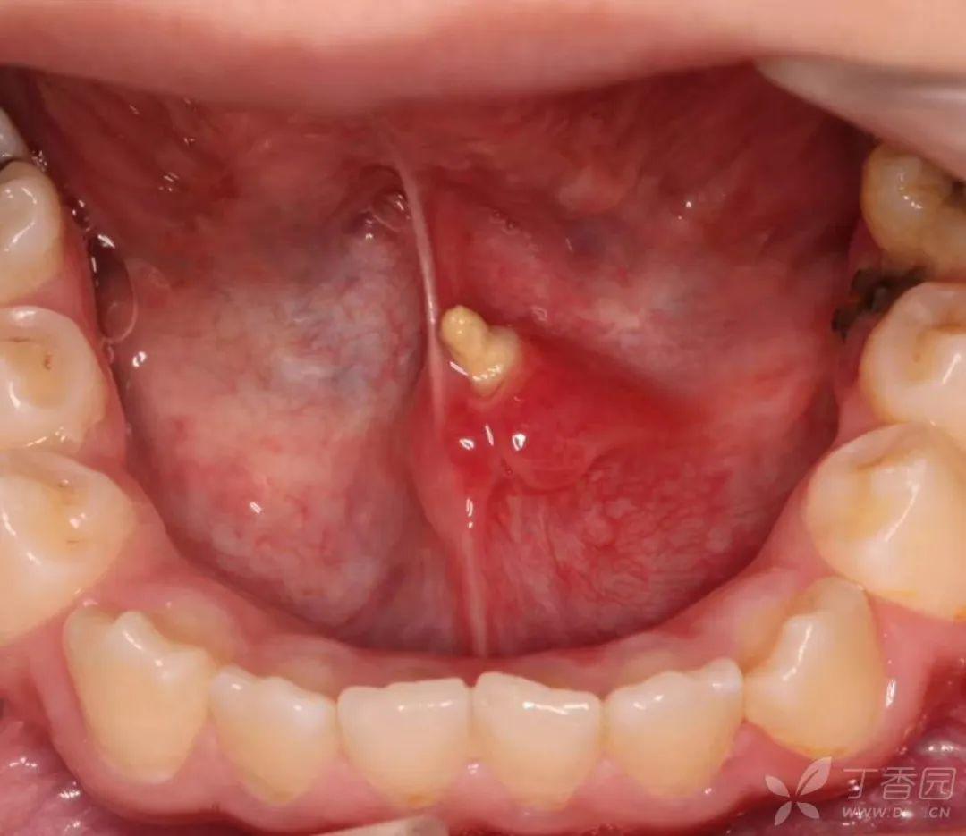 口腔内壁凸起一条肉棱图片