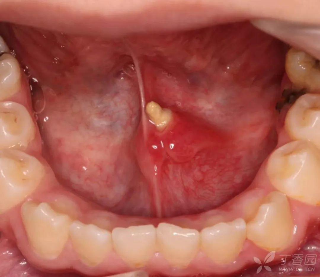 口腔息肉照片 侧壁图片