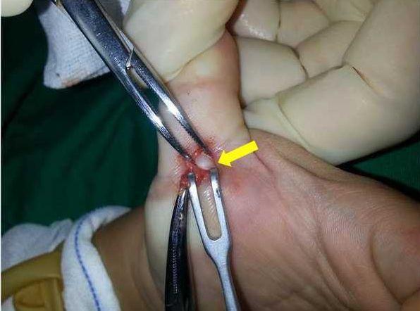 松解手术:通过小切口把腱鞘切开,或者切除一部分,肌腱和腱鞘之间的