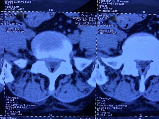 渭南市第二醫院神經脊柱外科成功治癒腰5骶1腰間盤突出症患者