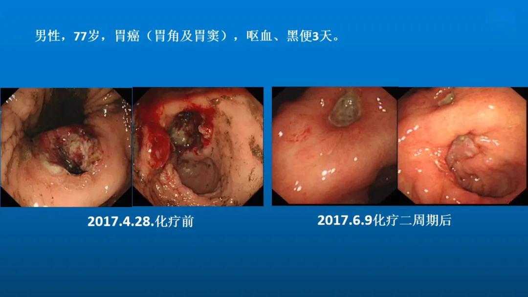 教学ppt消化道晚期恶性肿瘤出血的内镜治疗