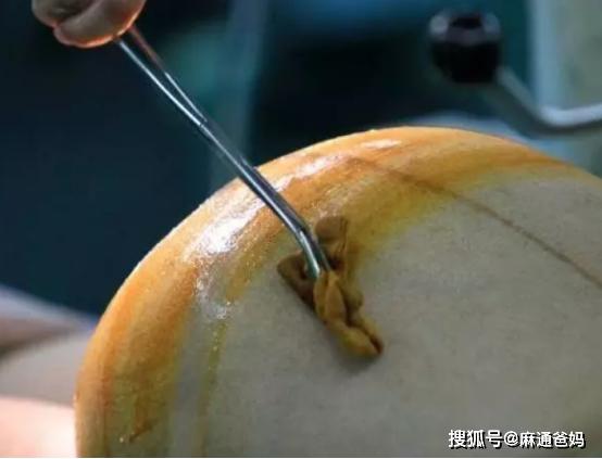 两次剖腹产都竖切疼得无法走路最怕护士来压伤口