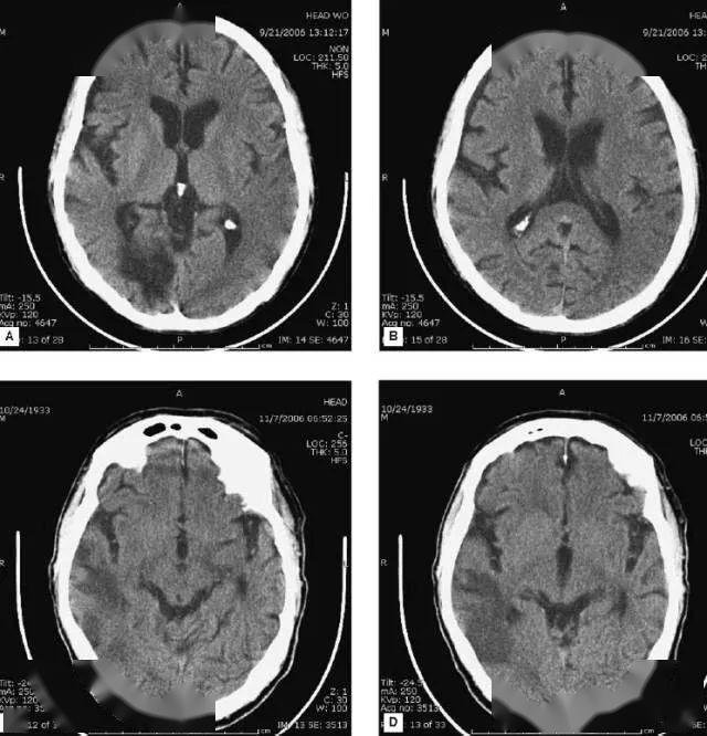 正常脑部ct片子图片图片