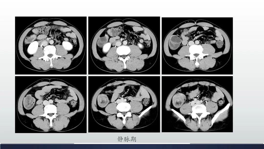 空肠淋巴管瘤图片