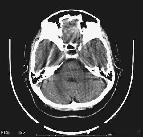 简明又详细的头部ct读片详解收藏