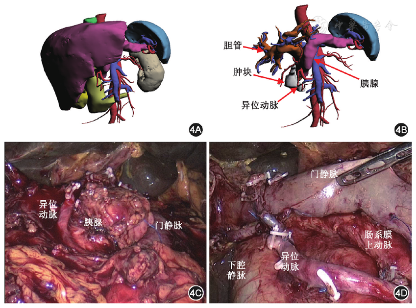 第四届金手指大赛获奖者经验谈胰腺领域