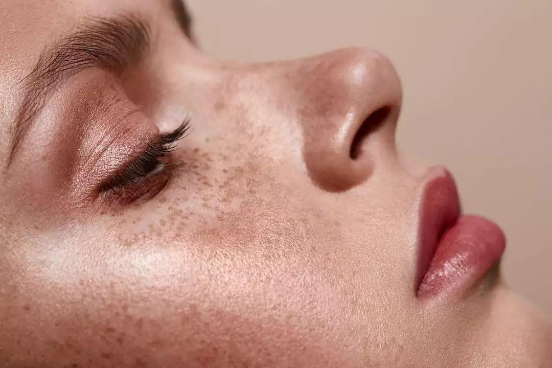 这5种食物越吃雀斑越严重皮肤真的差女生要少吃