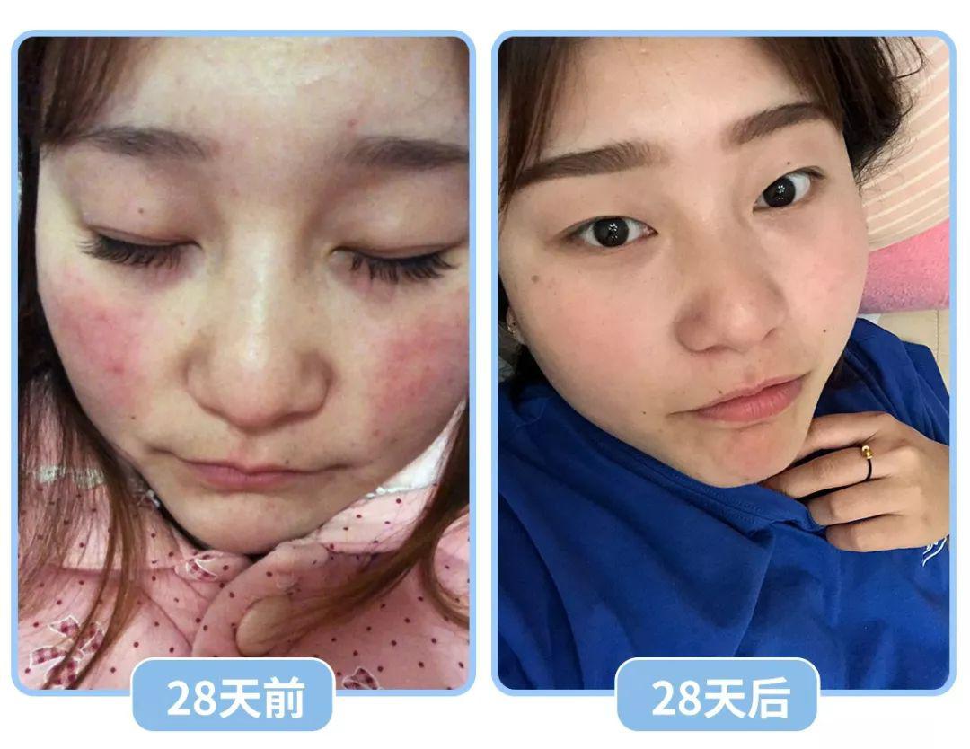 "红肿瘙痒没有了! 敏感肌福音 "